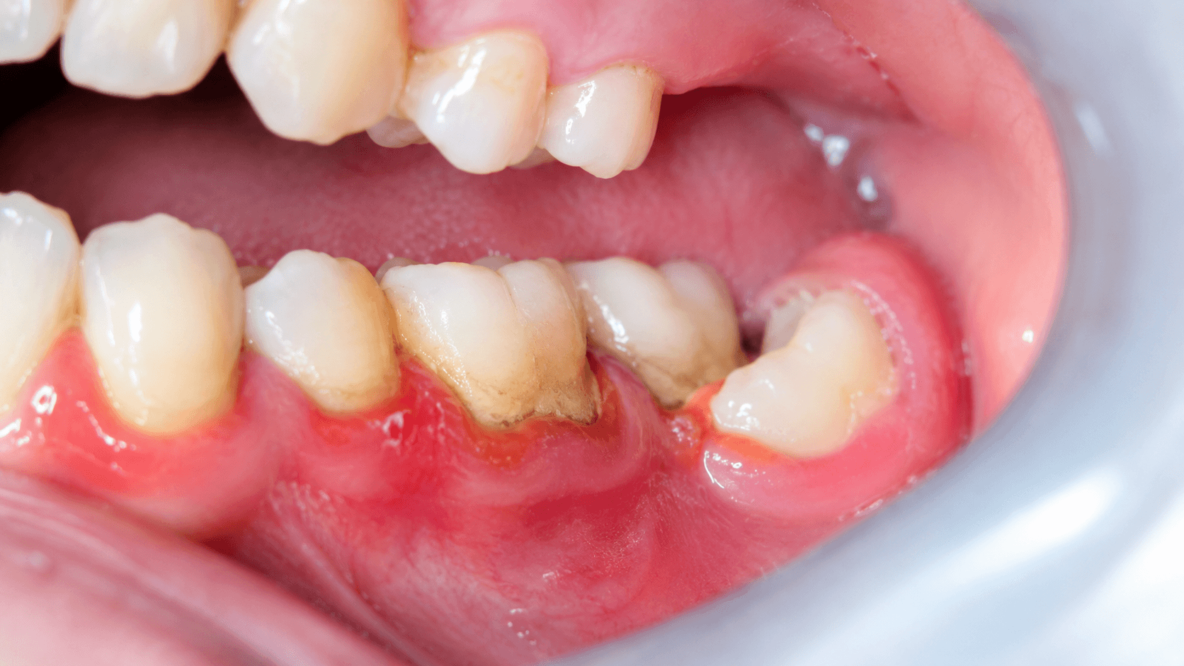 歯茎の腫れで見られる症状を確認するイメージ