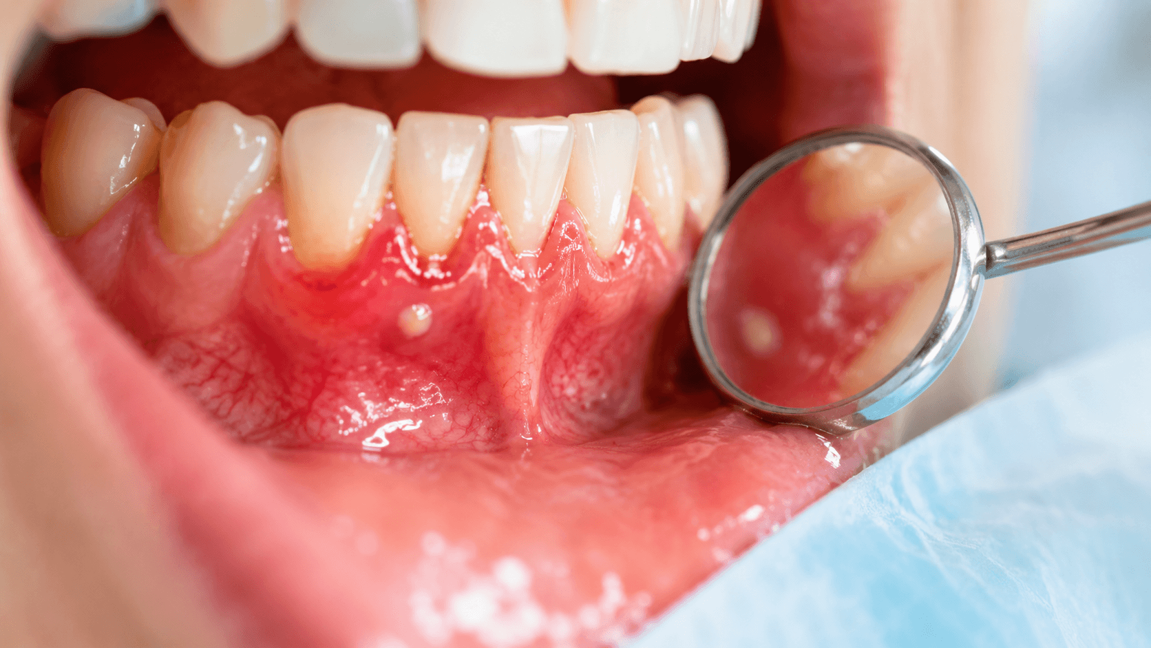 歯茎が腫れる主な原因を説明するイメージ