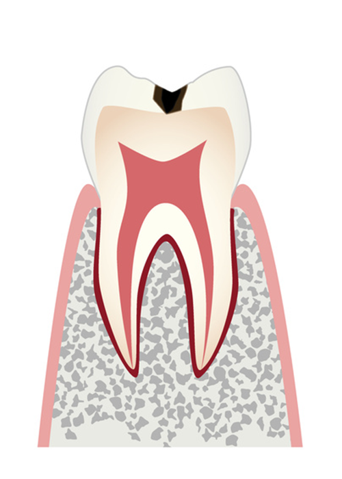 表面の虫歯