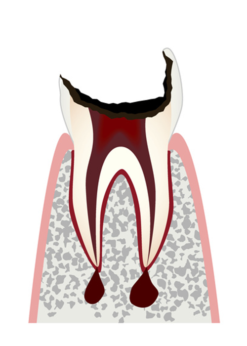 歯の根元だけ残っている虫歯